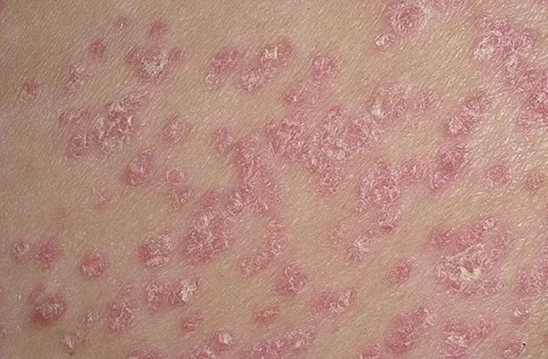 Psorilin: За кожата | Псориазис – симптоми, причини и решения