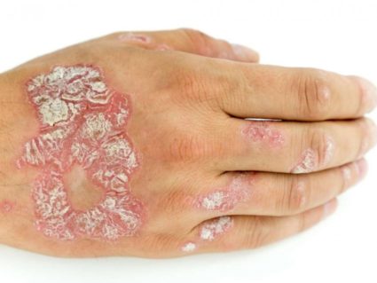Псориазис по ръцете симптоми